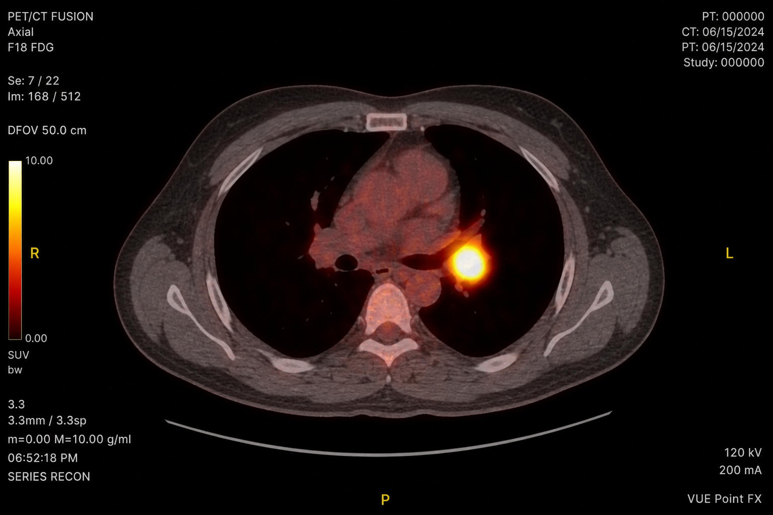 TNM staging prediction from PET/CT fusion